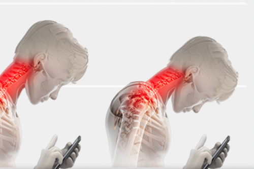 Tech Neck—What It Is and How to Treat It