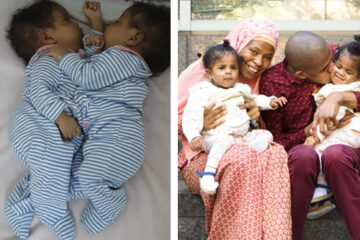 Photos of conjoined twins before and after separation surgery