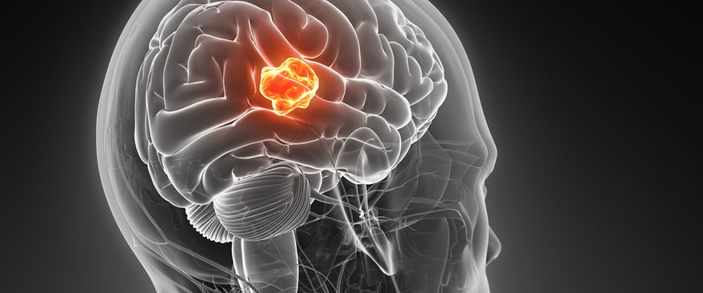 Understanding Glioblastoma The Most Common Type Of Malignant Brain Tumor