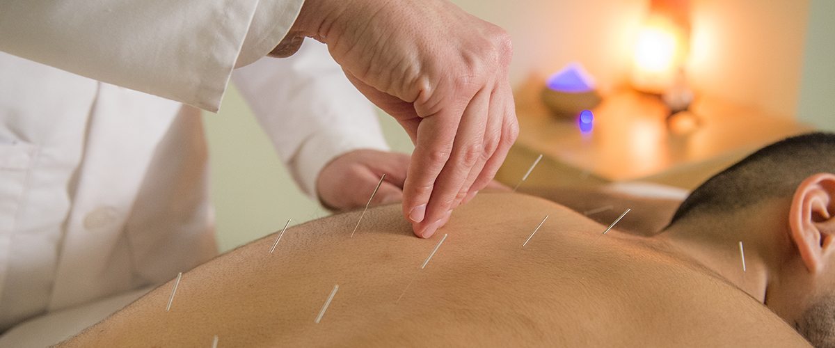 A man receiving acupuncture on his back