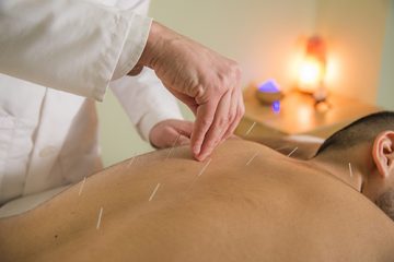 A man receiving acupuncture on his back