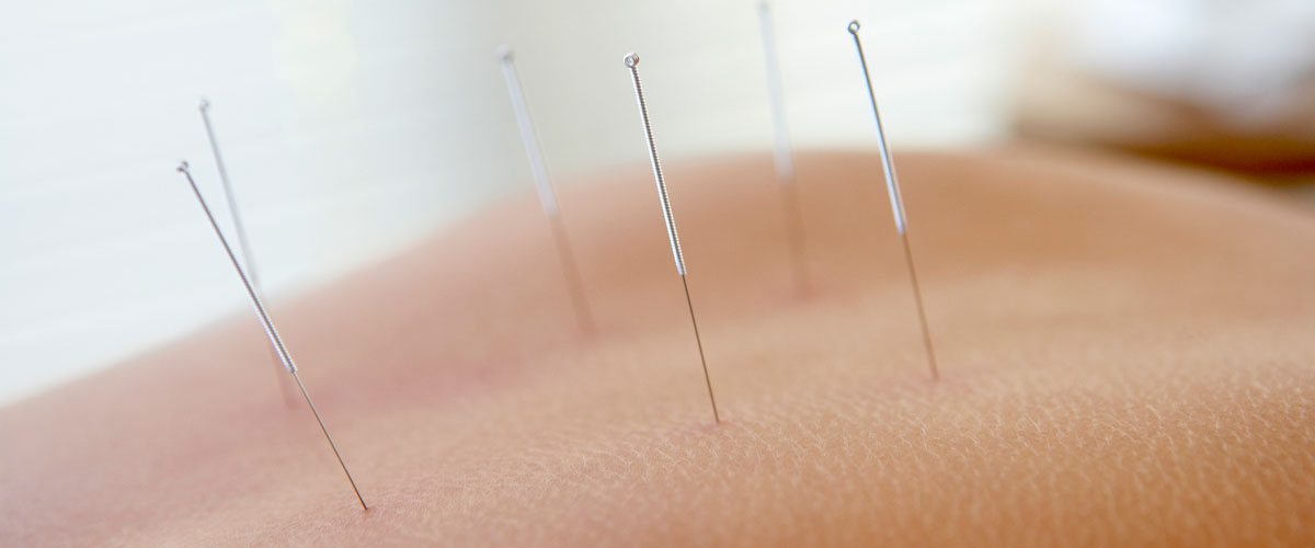Acupuncture needles in a patient's back