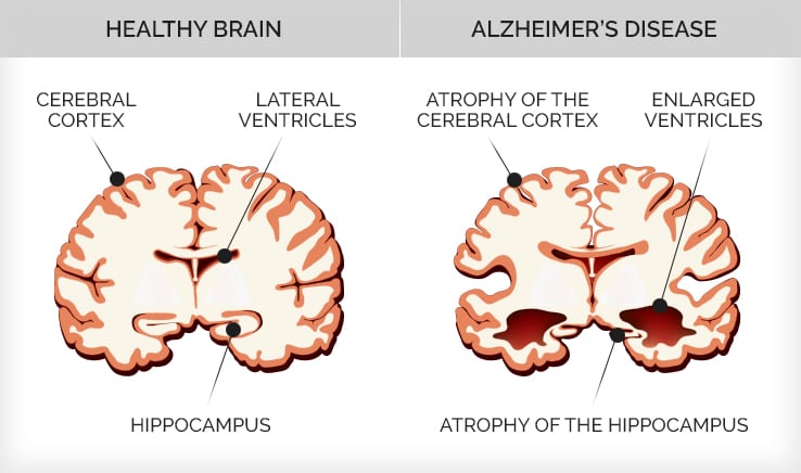 Infographic depicting the difference between a healthy brain and one with Alzheimer's disease