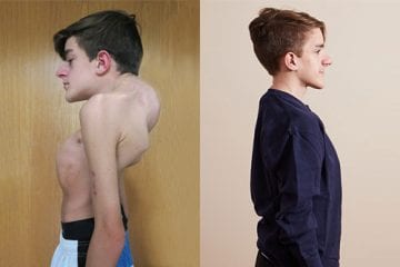 John Sarcona through different stages of scoliosis