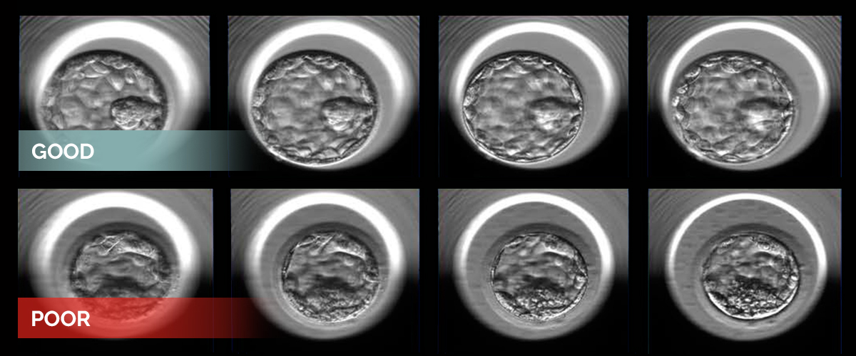 Two examples of human embryos at the blastocyst stage photographed at multiple focal depths