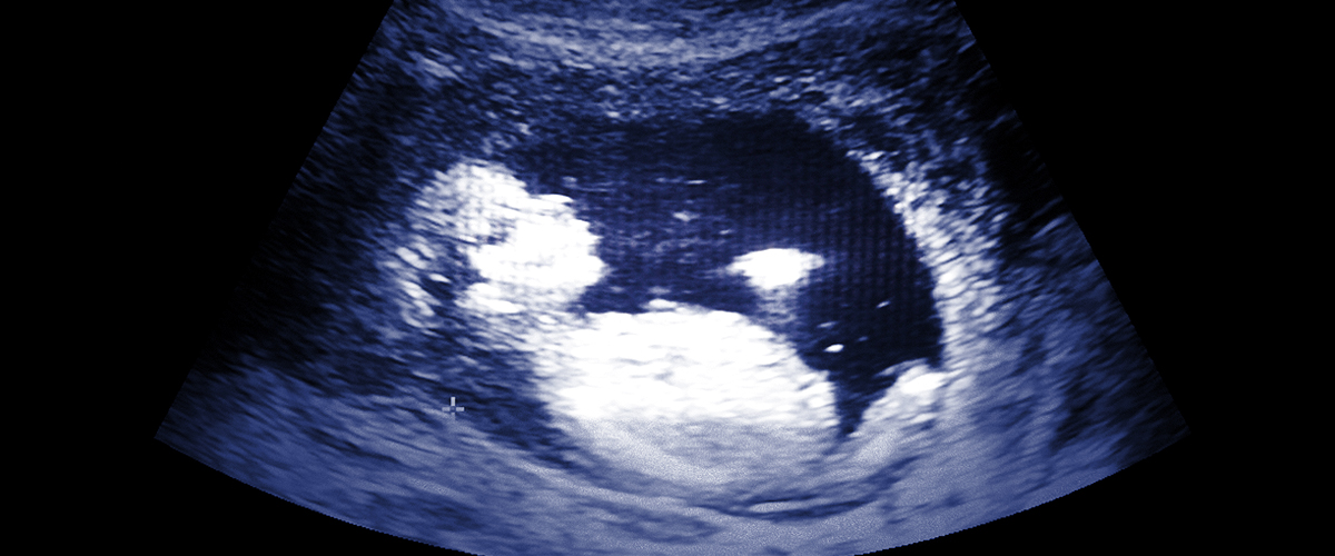Sonogram image of an embryo