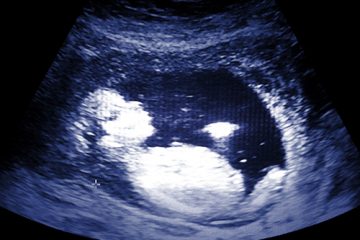 Sonogram image of an embryo