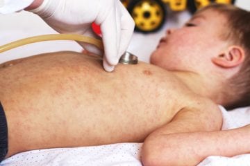 A child with measles being examined