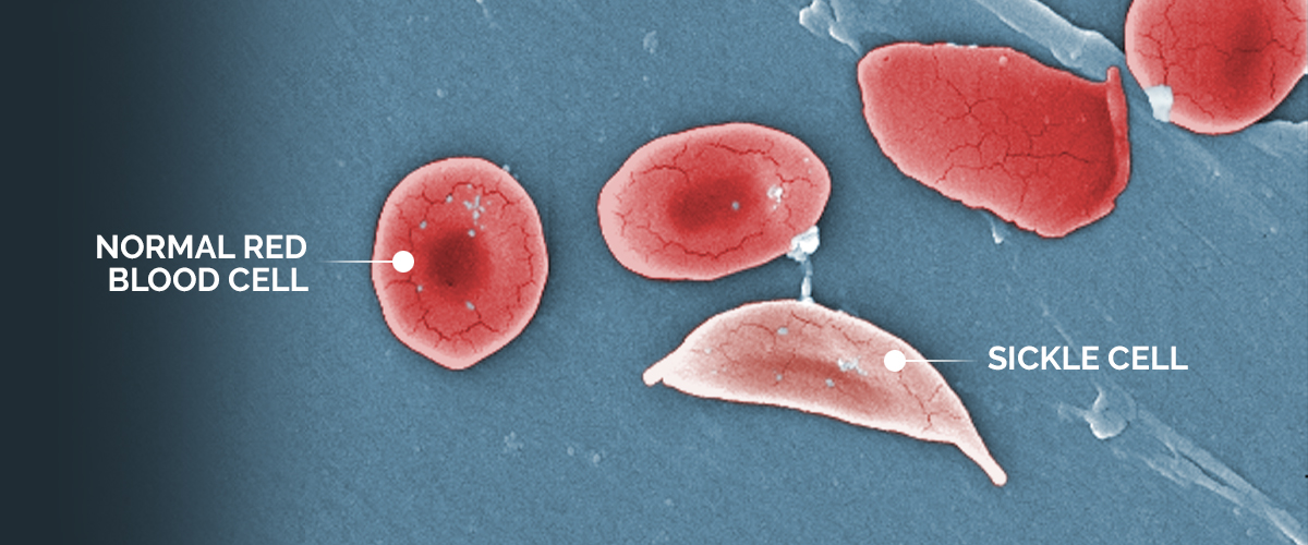An image showing the structural difference between normal red blood cells and a sickle cell red blood cell