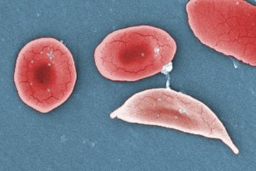 An image showing the structural difference between normal red blood cells and a sickle cell red blood cell