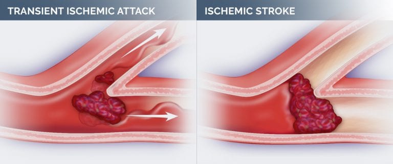 stroke-risk-factor-living-healthy-hawaii