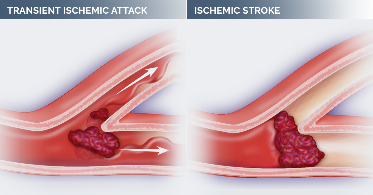 What Is A Mini Stroke 