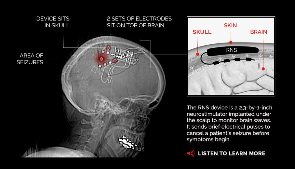 A Routine Brain Surgery for Epileptic Seizures Proves Lifesaving in a ...