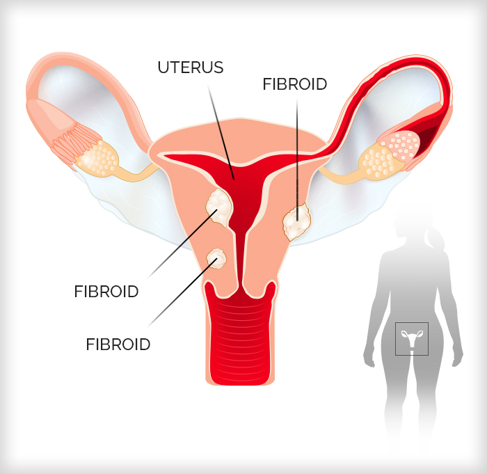Uterine fibroid graphic
