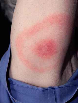 Typical Lyme disease bullseye rash.