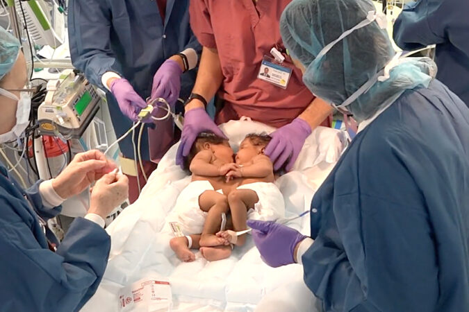 Inside The Successful Separation Surgery Of Conjoined Twins