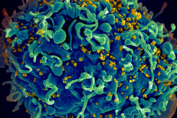 A human T cell under attack by HIV. A patient may have received an HIV cure.