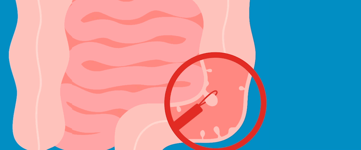 Animation showing how polyp is removed during colonoscopy