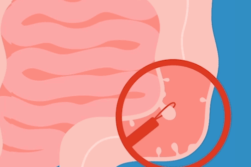Animation showing how polyp is removed during colonoscopy