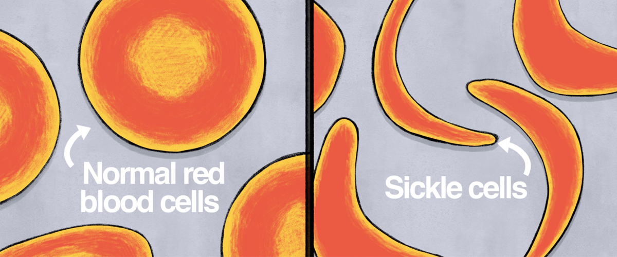 Sickle cell vs normal cell