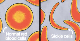 Can Gene Therapy Cure Sickle Cell Disease? 