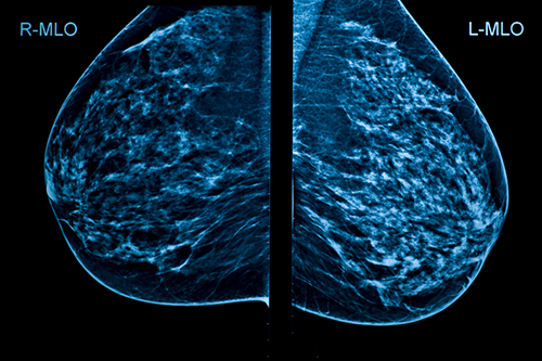 Breast Density Information To Become A Regular Part Of Mammogram