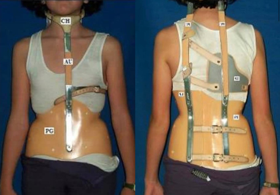 An example of the scoliosis brace Karen had to wear for 7 years.