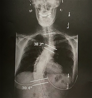 X-ray of Karen's spine just before corrective surgery showing the severity of the curve.