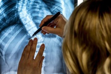 A doctor marks an x-ray of the curve of the spine of a scoliosis patient to prep for minimally invasive surgery.