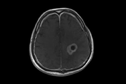 New Approach for Treating Glioblastoma