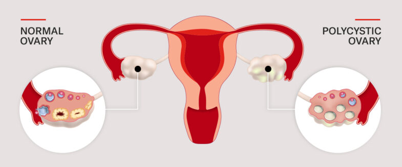 What Are the Symptoms, Treatments, and Complications of PCOS? - Women's ...