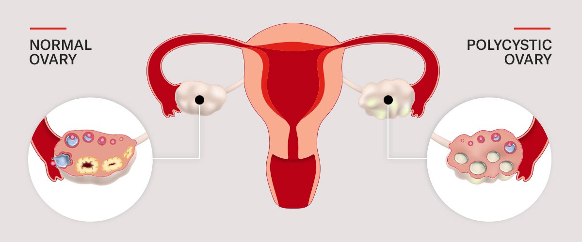 Ovarian Cyst Symptoms: How They Develop, How to Treat Them - University  Health News
