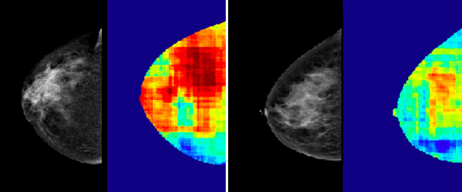 Can Artificial Intelligence Predict Breast Cancer?