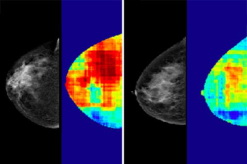 Can Artificial Intelligence Predict Breast Cancer?