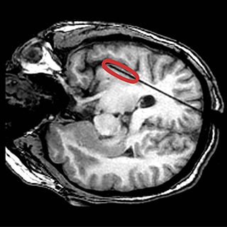 MRI image of a laser fiber penetrating Gianna's brain and going into her insula, which is circled in red.