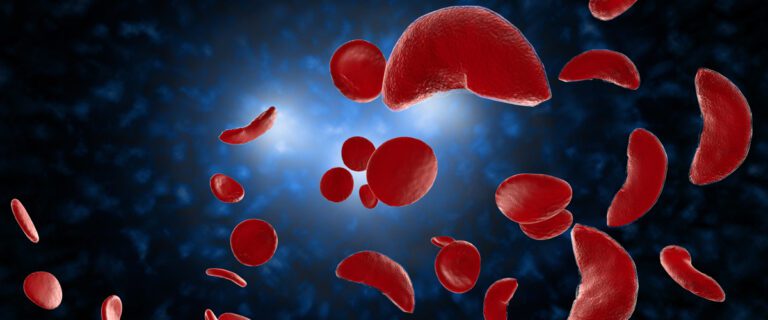 Fda Approves First Gene Therapies To Treat Sickle Cell Disease 