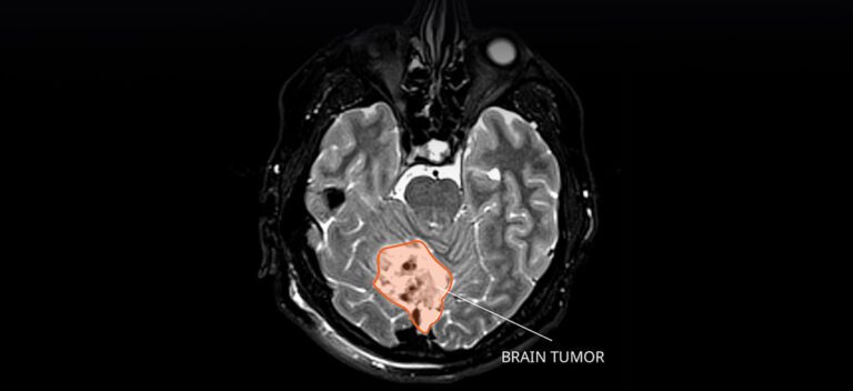 What To Know About Medulloblastoma