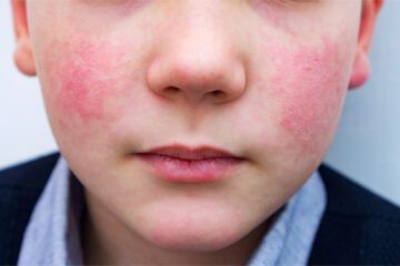 Boy with parvovirus rash slapped cheek syndrome