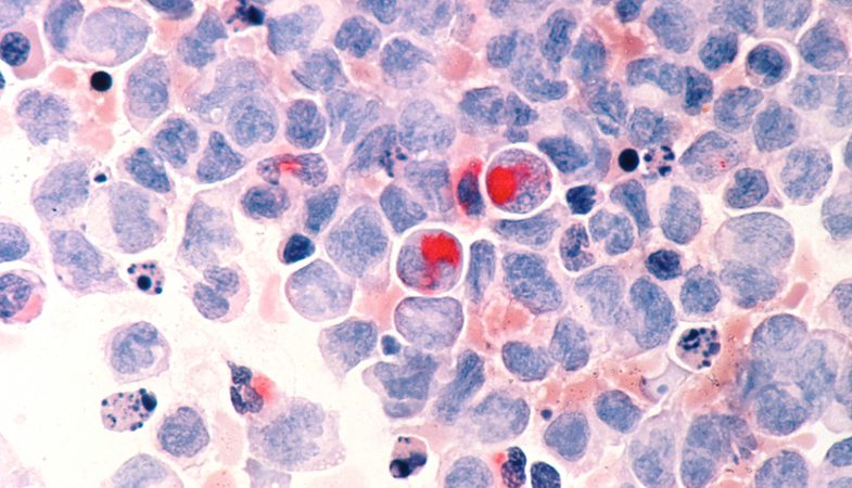 blood cells and cancer cells under a microscope