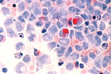 blood cells and cancer cells under a microscope